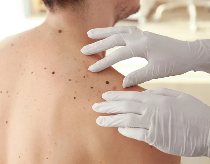 mappatura nei giulia tadiotto cicogna dermatologo dermatologa padova conegliano vittorio veneto