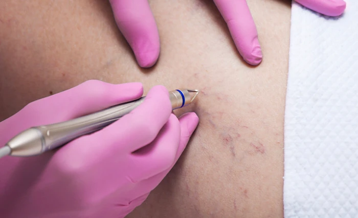 trattamenti laser epilazione alessandrite macchie tatuaggi capillari giulia tadiotto cicogna dermatologo dermatologa medicina estetica laser padova treviso conegliano vittorio veneto